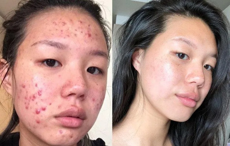trị mụn tận gốc