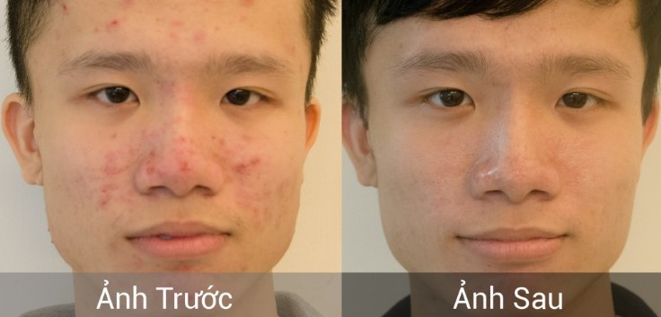 Điều trị da mụn cho nam