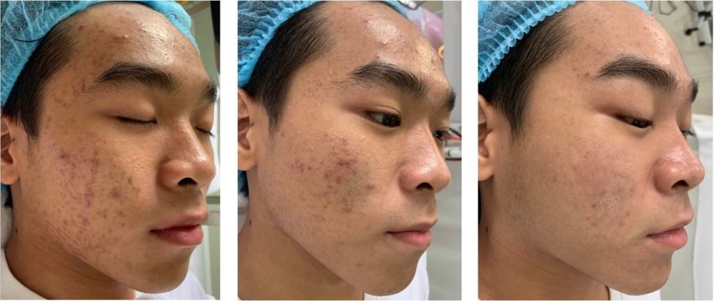 Điều trị da mụn cho nam tại TPHCM