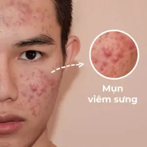 Điều trị da mụn cho nam