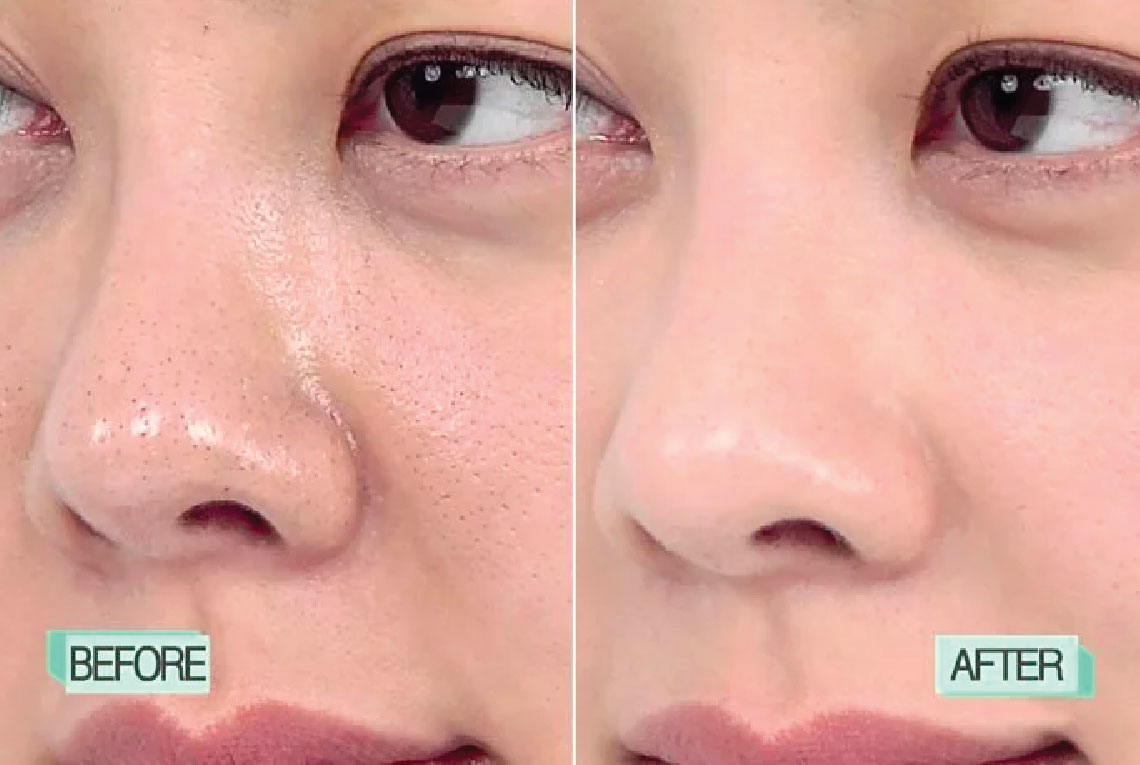 Điều trị da thu nhỏ lỗ chân lông