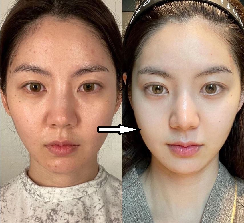 Điều trị da thu nhỏ lỗ chân lông tại TPHCM