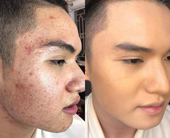 Điều trị da chuyên sâu giảm mụn thâm