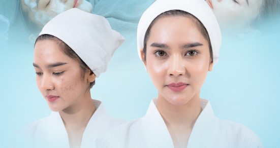 Spa trị mụn tận gốc tại Gò Vấp