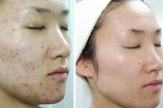 Chuyên điều trị mụn thâm nám dứt điểm