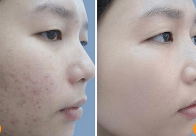 điều trị mụn thâm nám