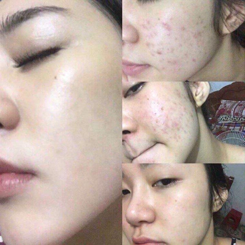 Địa chỉ nặn mụn uy tín