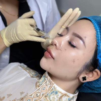Cấy Collagen