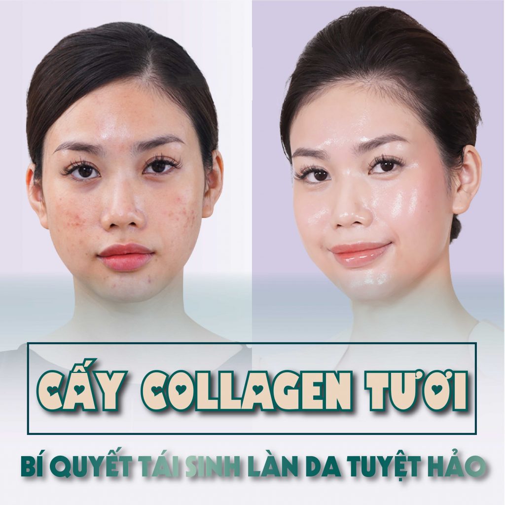 Cấy Collagen: Tái tạo làn da lão hóa sạm nám xỉn màu