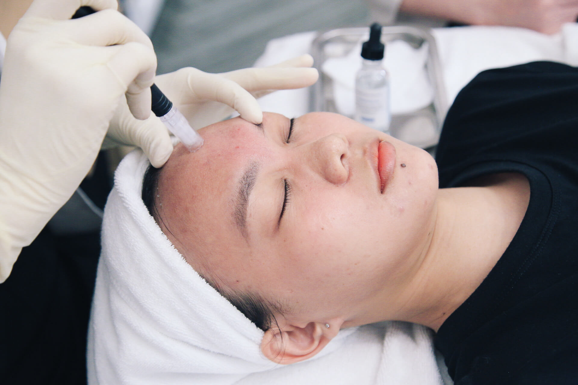 Lấy nhân mụn chuẩn y khoa