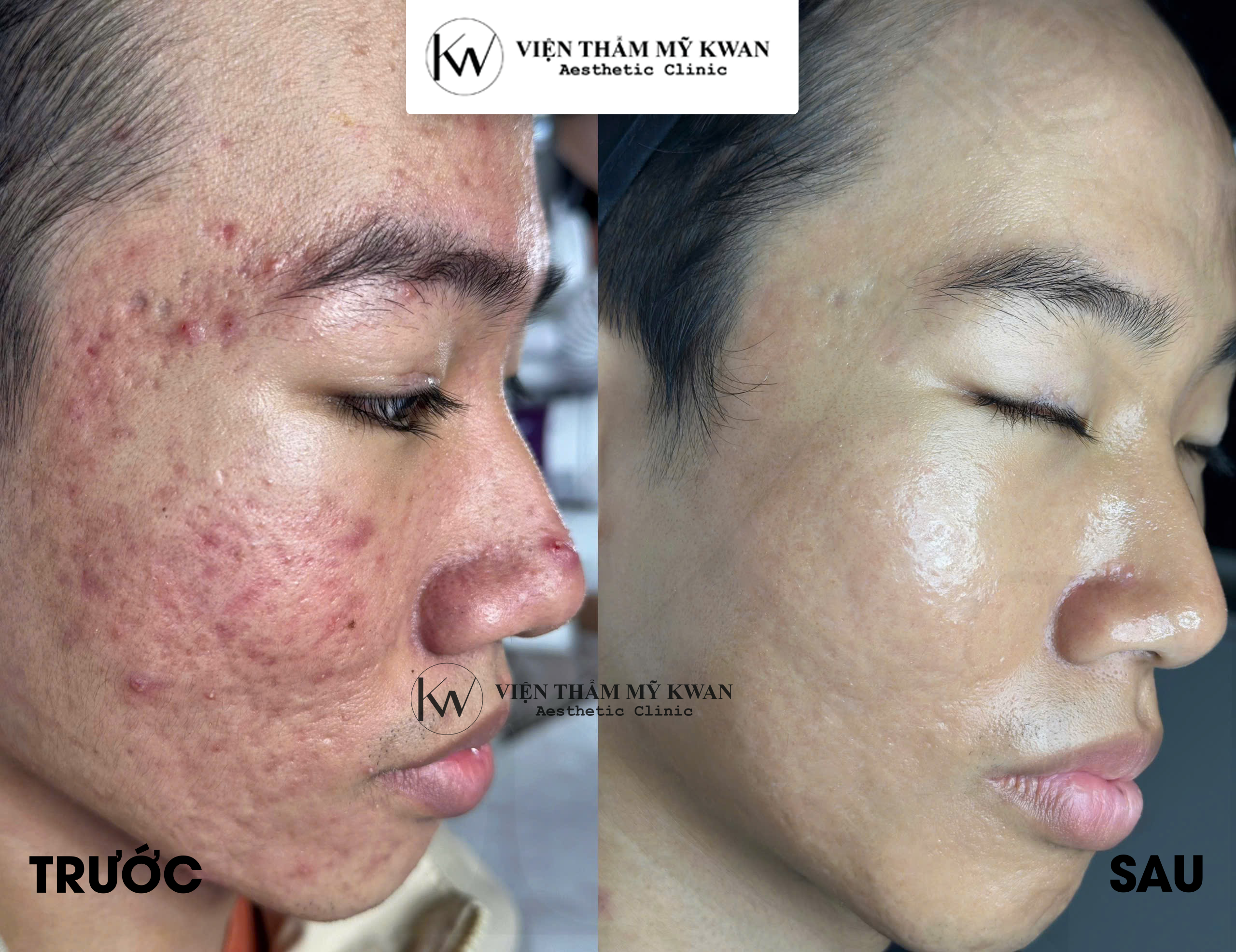 Chemical Peel