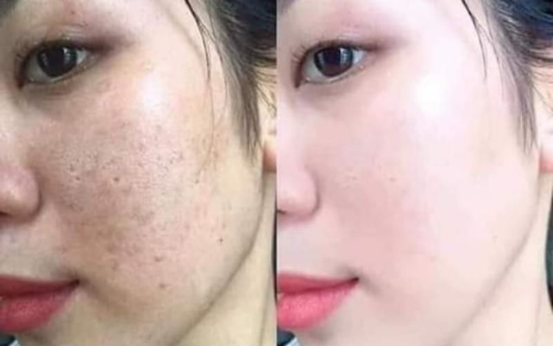 Điều trị da chuyên sâu giảm mụn thâm