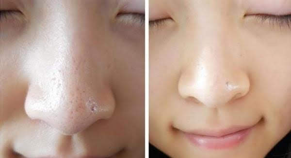 Điều trị da thu nhỏ lỗ chân lông