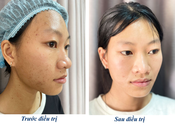 điều trị mụn thâm nám