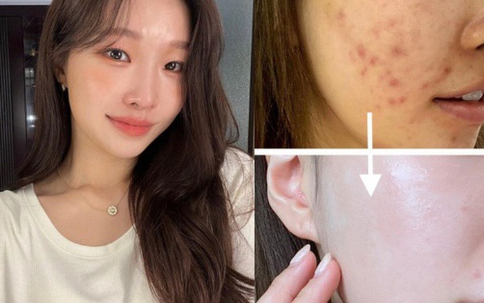 Địa chỉ nặn mụn uy tín tại Gò Vấp