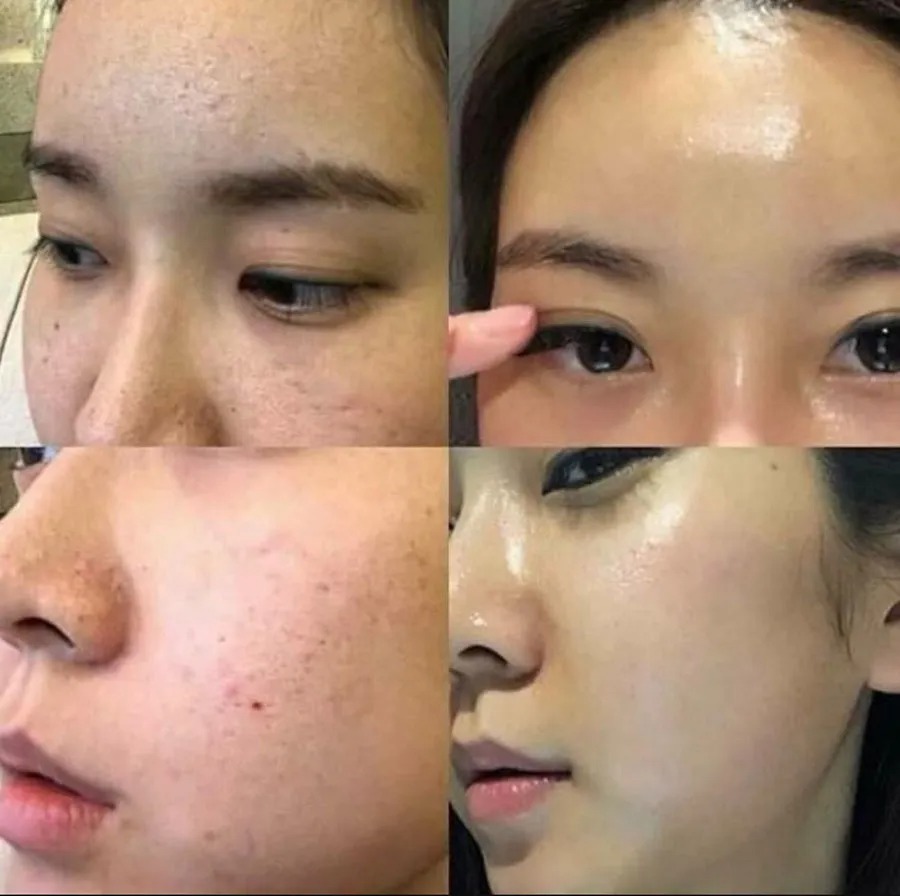 peel da trị mụn tận gốc
