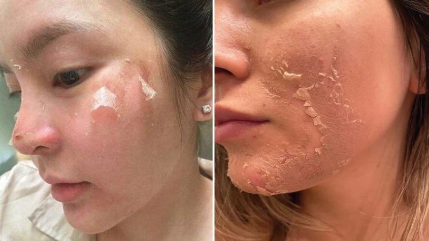 Địa chỉ peel da uy tín tại TPHCM