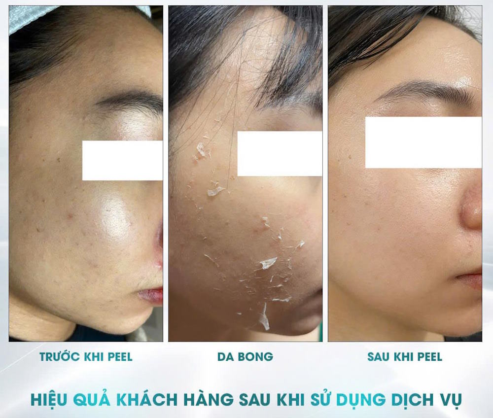 Địa chỉ peel da uy tín