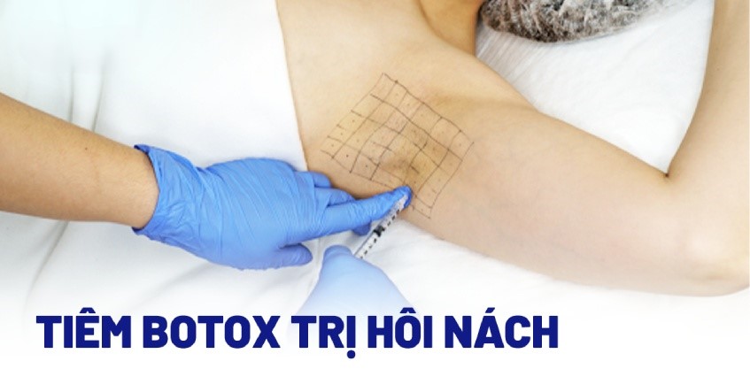 Trị tuyến mồ hôi