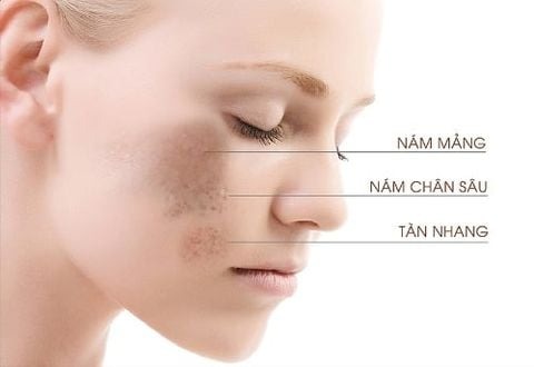 Viện thẩm mỹ trị nám uy tín tại TPHCM