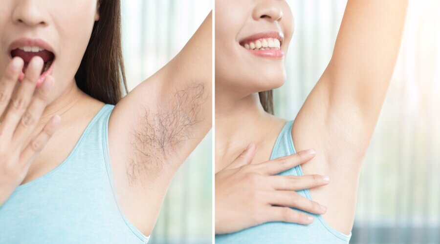 Triệt lông nách giá rẻ