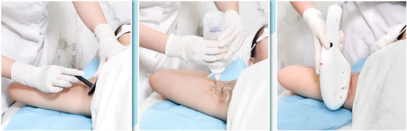 Spa triệt lông nách giá rẻ gần đây