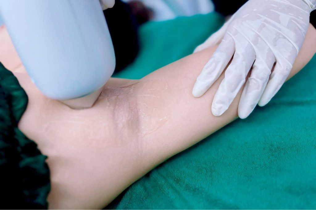 Triệt lông nách giá rẻ