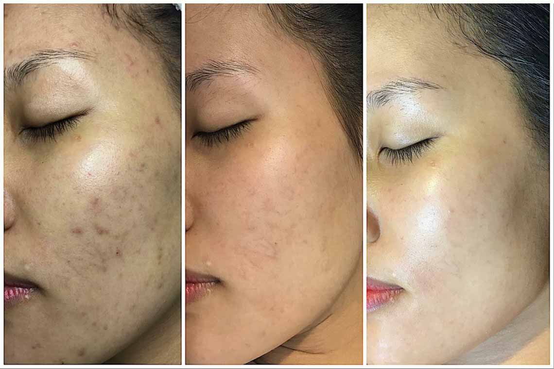 công nghệ trị mụn vi tảo